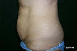 liposuction tummy tucks Perth consultation fee