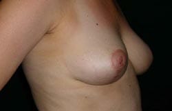 breast lift surgery After