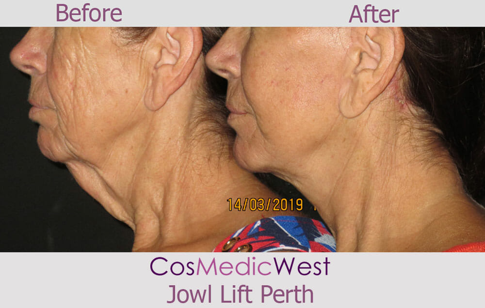 Affordable Jowl Lift in Perth