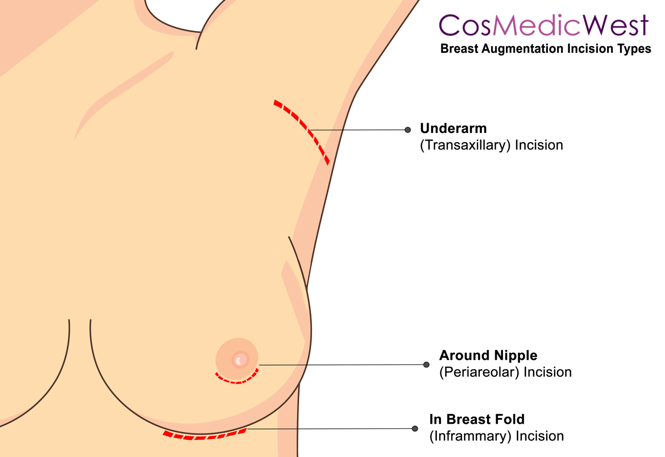 Perth's Breast implants Incision Types